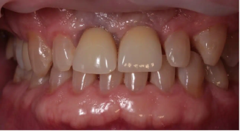 Pre-operative condition