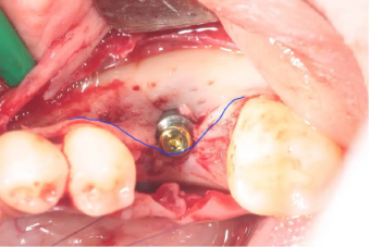 implant-placement-thin-alveolar-ridge