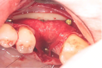 membfixation-sausage-technique