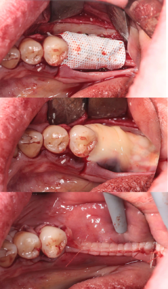 membrane-placement-coverage
