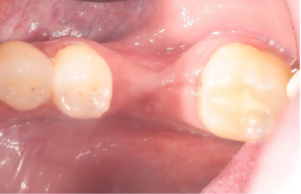 pre-op-thin-alveolar-ridge