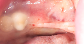 pre-operative-condition