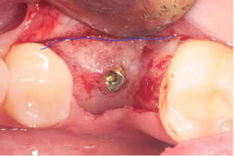 reopening-implant-uncovering