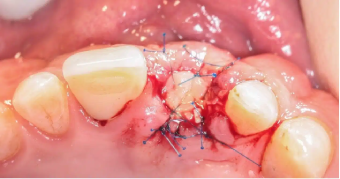 socket-sealed-sutured