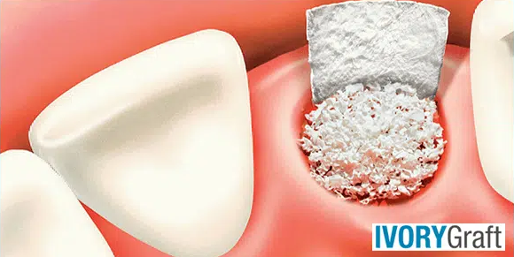 Dental Bone Graft – Applications