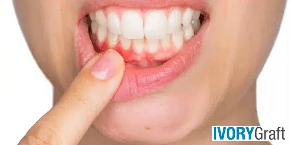 Dental Bone Graft – Complications