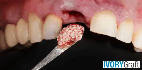 Dental Bone Graft – Overview