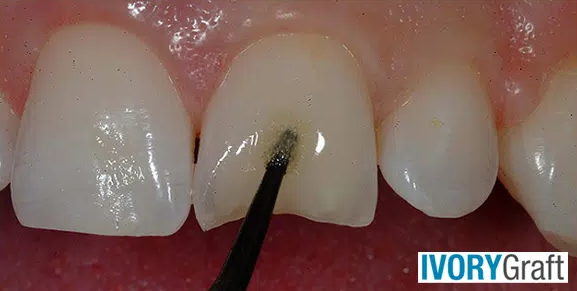 Dentin – Bonding Agents