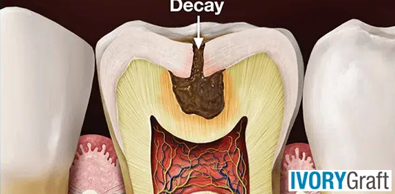 Dentin – Decay and Prevention