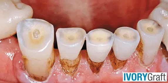 Dentin – Exposure and Tooth Wear
