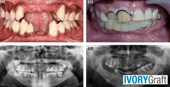 Dentin – Pathologies